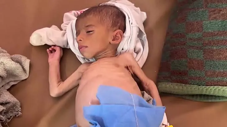 اليونيسف: ازدياد معدلات سوء التغذية بين الأطفال في غزة بوتيرة مقلقة