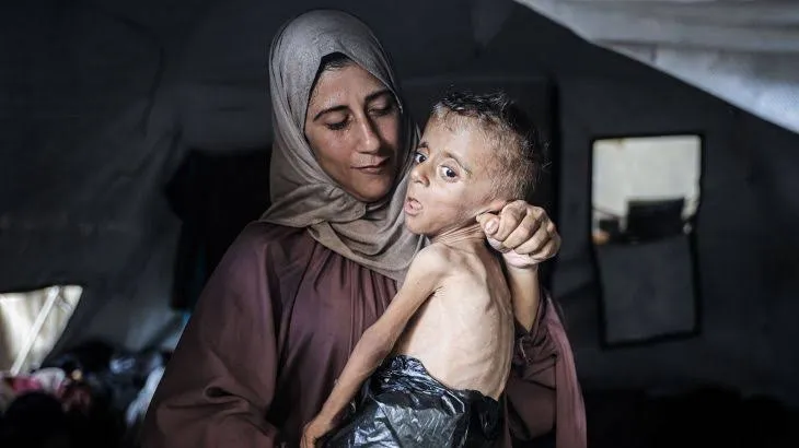 112 طفلا في غزة يدخل دائرة سوء التغذية يوميا