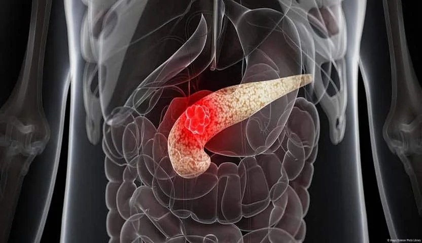 علاج مناعي بتقنية mRNA يخترق حاجز سرطان البنكرياس ويحقق نتائج واعدة