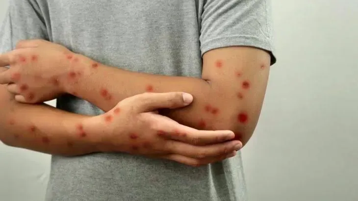 برلين تسجل أول إصابة بجردي القردة