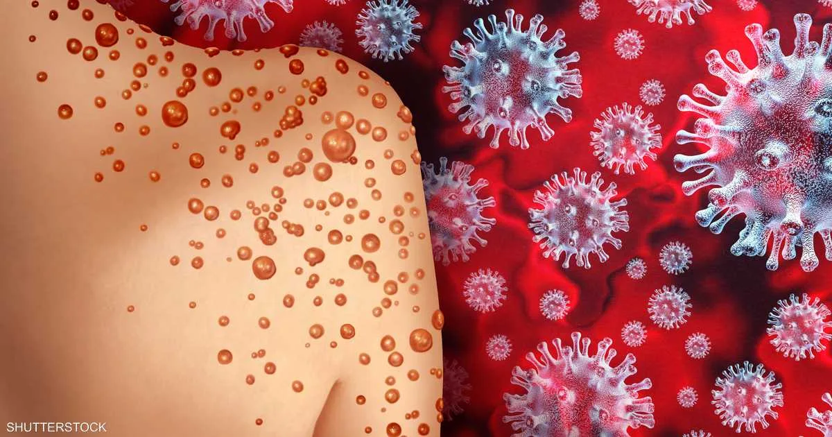 سبتة الإسبانية تسجل أول إصابة بجدري القردة لدى قاصر مغربي