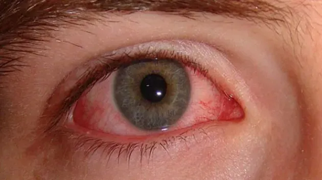 منظمة الصحة العالمية تهنئ الجزائر بنجاحها في القضاء على مرض الرمد الحبيبي